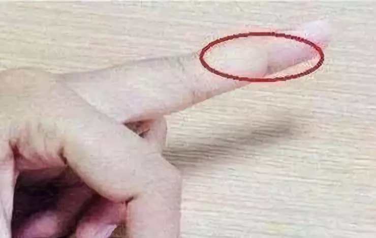 尿酸|手指上有了这种东西，说明你体内毒素可能堆积如山~