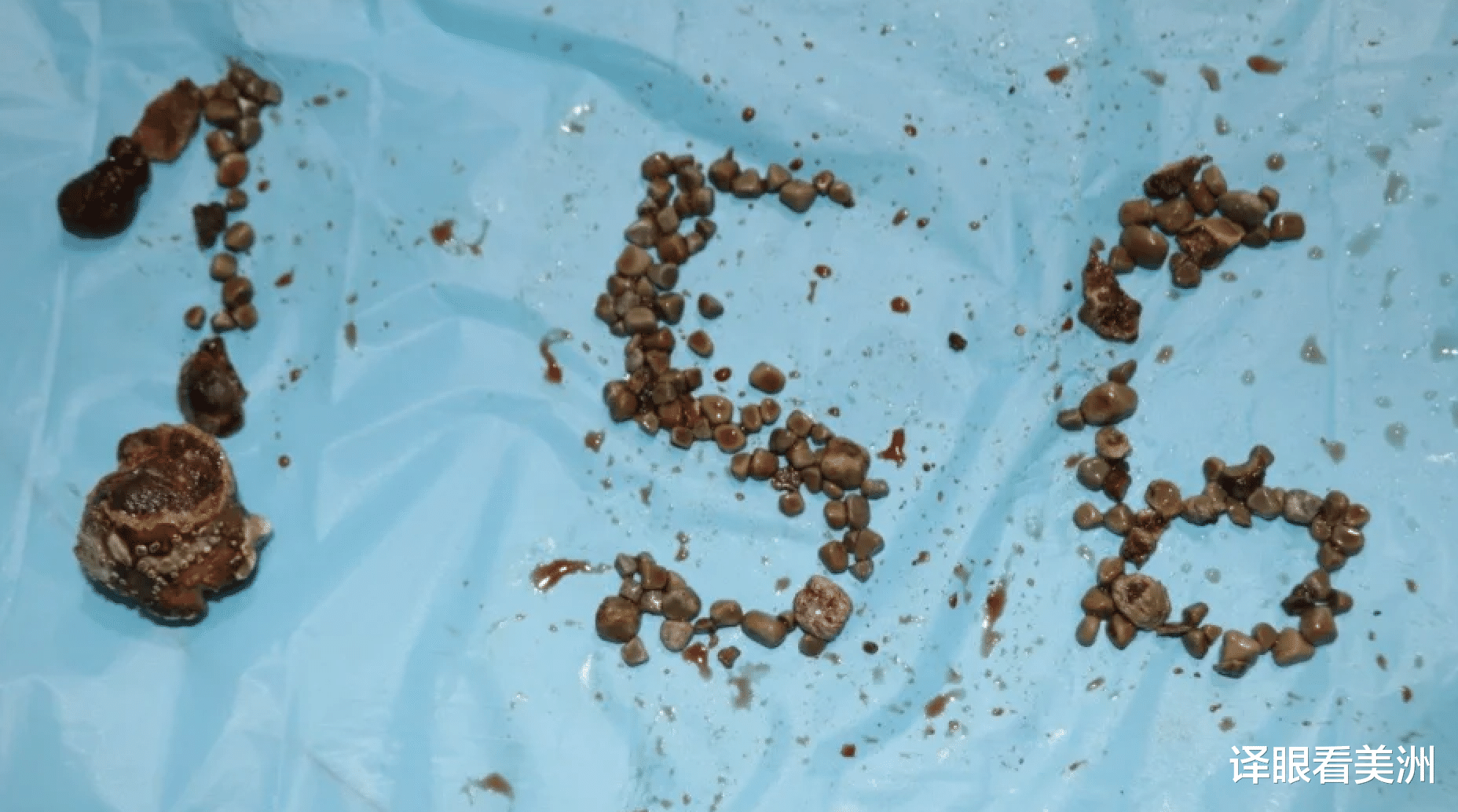 肾结石|156颗肾结石破纪录，50岁印度男子历经3小时取石手术