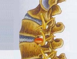 邱氏悬壶|腰椎间盘突出腿疼该怎么办?锻炼方法有哪些?邱氏悬壶