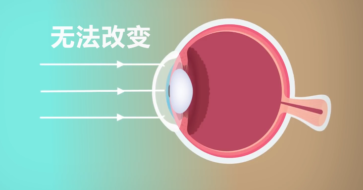 心房颤动|神奇的“菲涅尔透镜”原理，教你不用去医院，也能测出自己的近视度数!