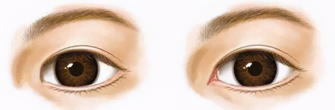 史迎军眼整形|史迎军眼整形 | 开眼角容易留疤、回缩吗？眼角到底该不该开？