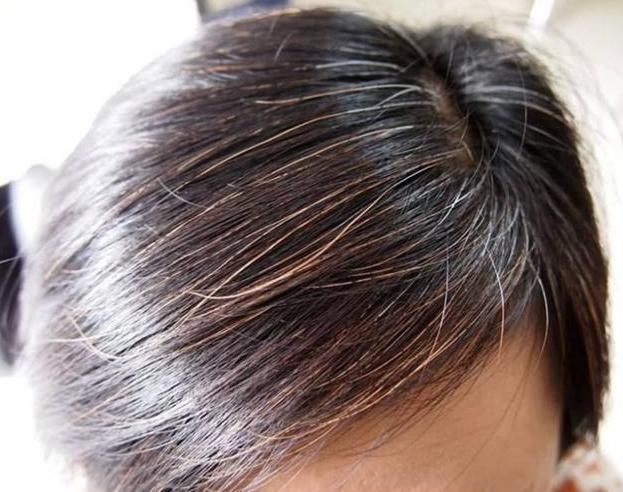 维生素B|为啥白头发越长越多？你以为是老了，医生：或是缺乏2种营养素