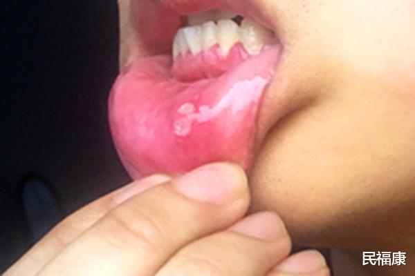 更年期|六大原因可能导致你常年被口腔溃疡“骚扰”，预防和治疗同样关键