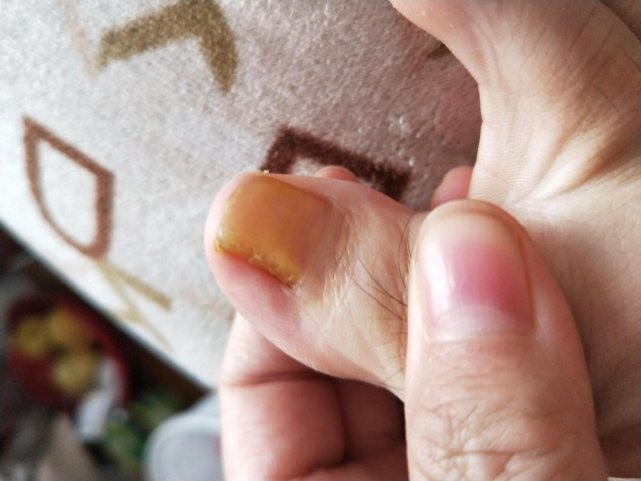 黎青努力中|灰指甲只能拔甲吗？断根的方法交给你，让指甲光亮如初不再复发！