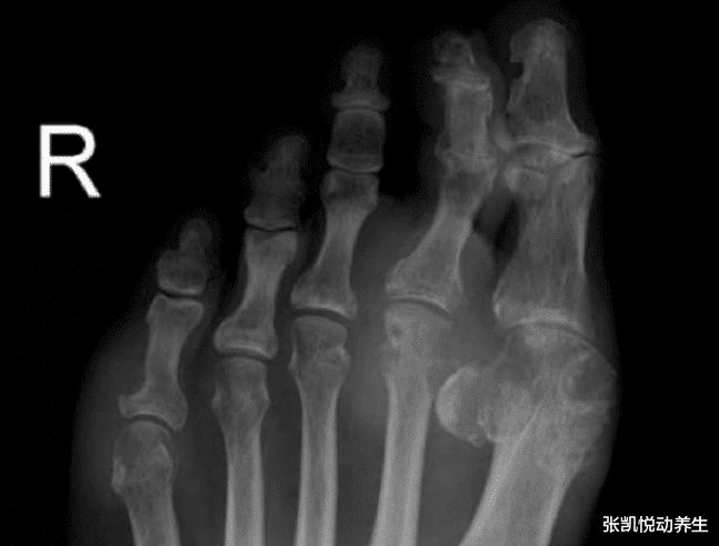 痛风|55岁男子尿酸高680，痛风发作离世，提醒这3种食物，再馋也要少吃