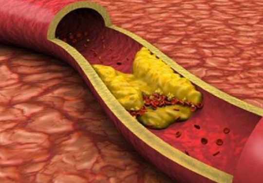 高血脂|吃一口等于10斤苦瓜,高血脂患者常吃,清血管防血栓,远离脑梗