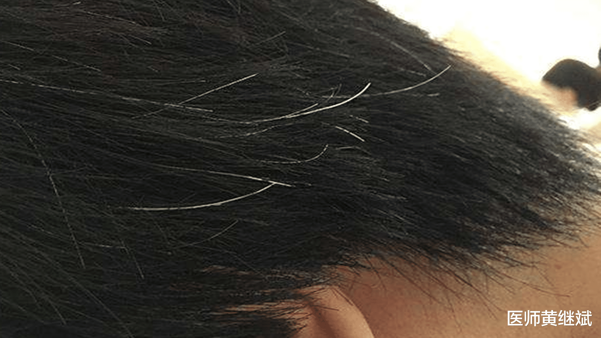 骨折|白头发增多，有可能是缺乏营养，不一定年纪大才头发白