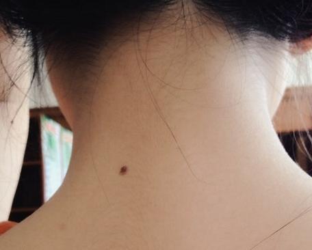 色素痣|别把癌症误认为是黑痣，对照一下，5种方法教你分辨！