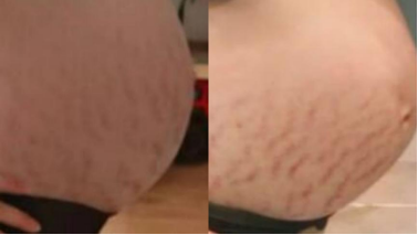 樱桃妈咪|“毁容式”怀孕之妊娠纹:10个孕妈9个花肚皮,宝妈教你正确淡化