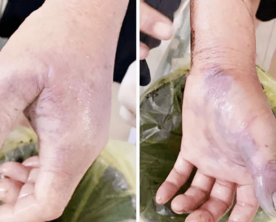 朝鲜|黄颡鱼刺一下,手指却被截肢,黄辣丁这么厉害么?其实还怪自己