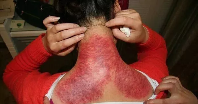 刮痧|您对刮痧了解多少?