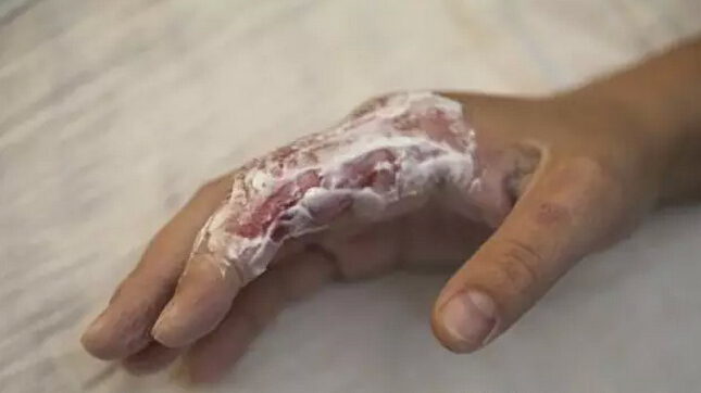 菁妈育儿|孩子打翻热面,妈妈被烫伤痛得跳开,一个反应让人感叹:母爱伟大