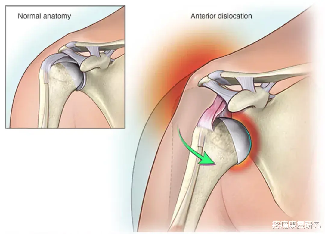 熬夜|三种常见的肩关节脱位及治疗