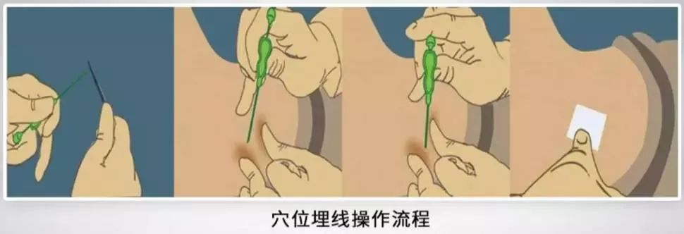 红豆|中医最方便的减肥法：穴位埋线法