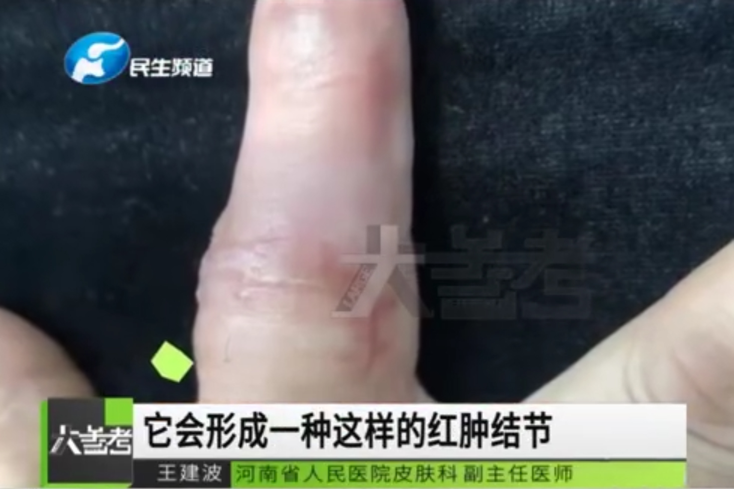 中风|女子被鱼刺扎破后浑身长满疙瘩