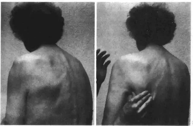 脑卒中|脑卒中肩关节半脱位的早期综合分析与康复治疗