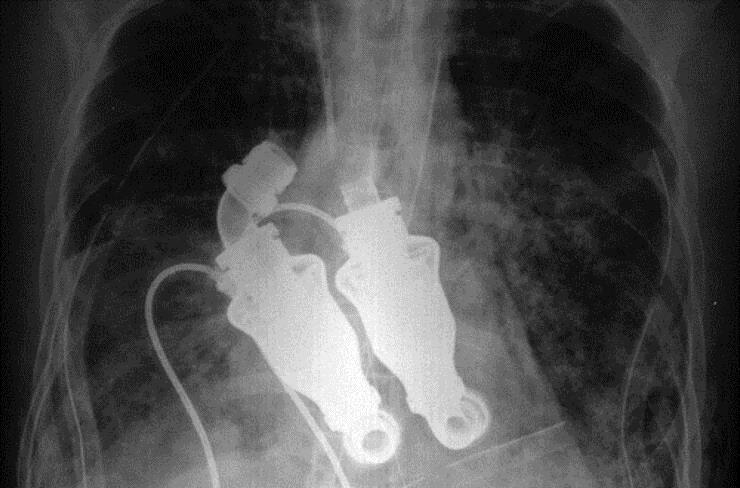 机器|10年前，全球首位无心人出现，没有心跳脉搏，机器停止就死亡