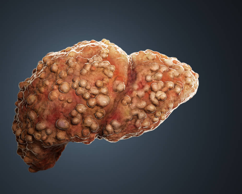 降压药|这些行为，或会加速肝硬化，尽快改正，把肝硬化“拦在门外”