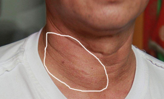 甲状腺结节|45岁大哥坚持3个好习惯，甲状腺结节半年消散，医生：主要靠是自律