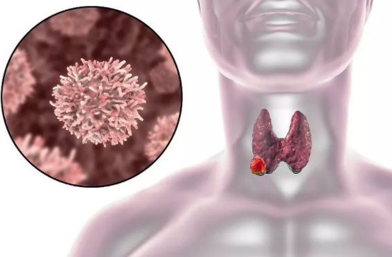 运动|卫生组织声明:停止食用1种水果,它正在“掏空”你的甲状腺,趁早扔