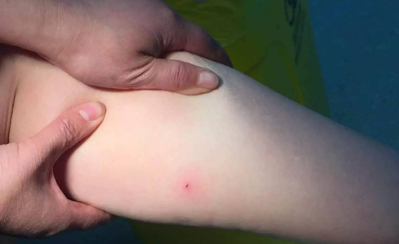 90育儿|夏天蜱虫多，孩子被咬后别硬拔，宝妈学会三个急救法，医生都夸好