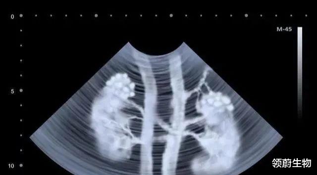 肾衰竭|干细胞移植有望代替透析、换肾，肾衰不再别无选择！