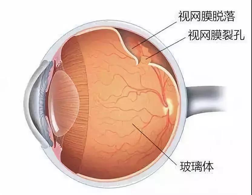 广元EYE小霸王|视网膜脱离什么时候做手术好？