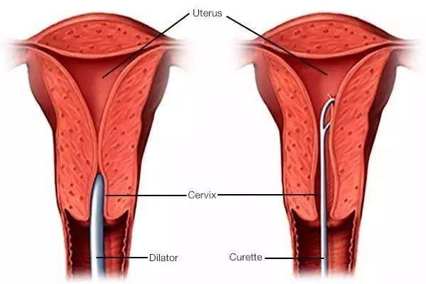 郑州中原科大医院|抑郁女性更容易患上子宫腺肌症吗？