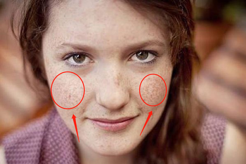 黑色素|2种食物是色斑的“清道夫”,敞开吃!斑点少,气色好,人漂亮!