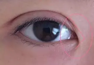 史迎军眼整形|史迎军眼整形 |坐双眼皮，一定要开内眼角吗？