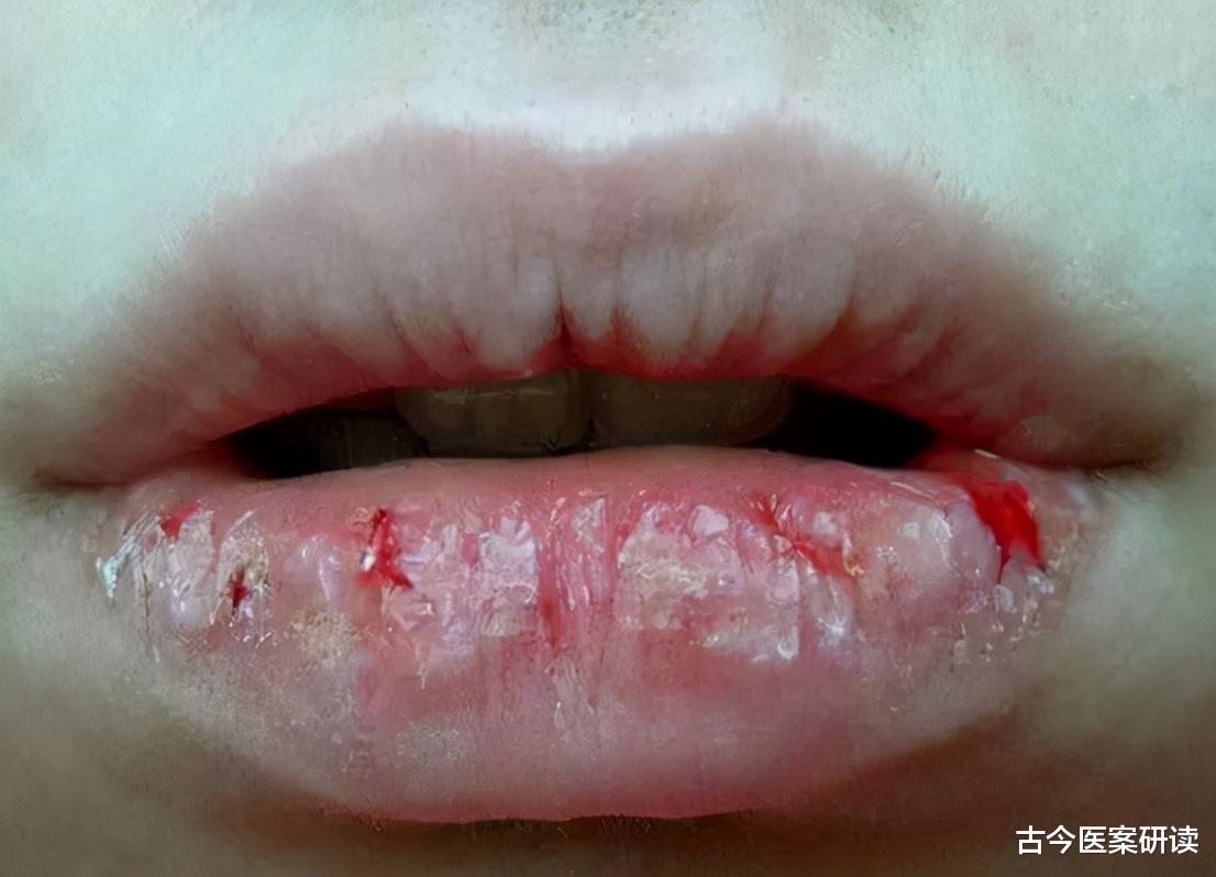 古今医案研读 嘴唇出现干裂脱皮，不能舔不能撕开，后果很严重！