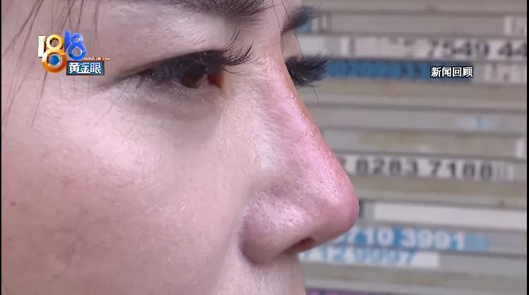 美容 养生馆里隆鼻变红鼻子后续：鼻子还是红， “冤家”成“姐妹”？