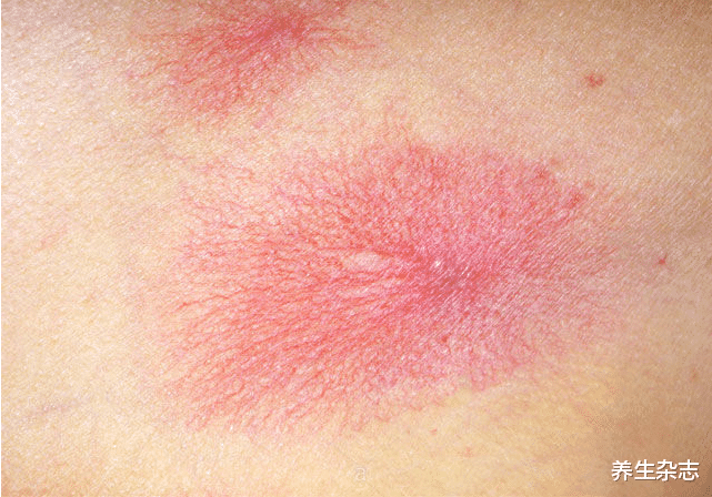 肝硬化|35岁男子“内卷”5年,确诊肝硬化1月离世,医生叹息:“内卷”害人不浅