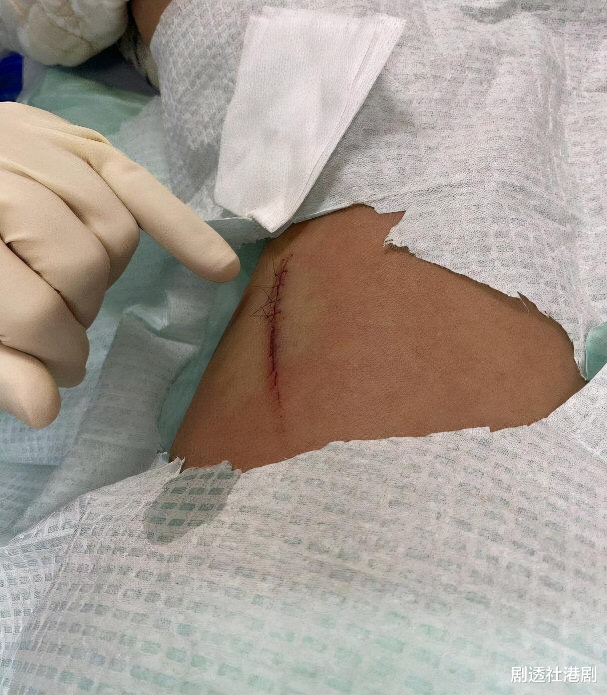 卫诗雅|担心！英皇女星自曝平安夜受伤，大腿惊现血痕，入院缝四针