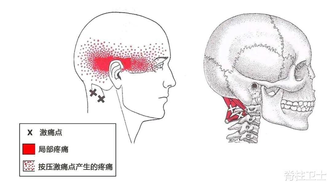 湿疹|脖子又酸又痛！怎样缓解颈肩酸痛？这里有答案