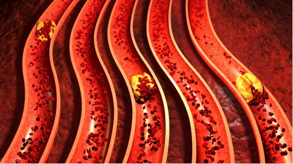 运动|食物界的“阿司匹林”已发现，每天坚持吃，让血管一天天变软