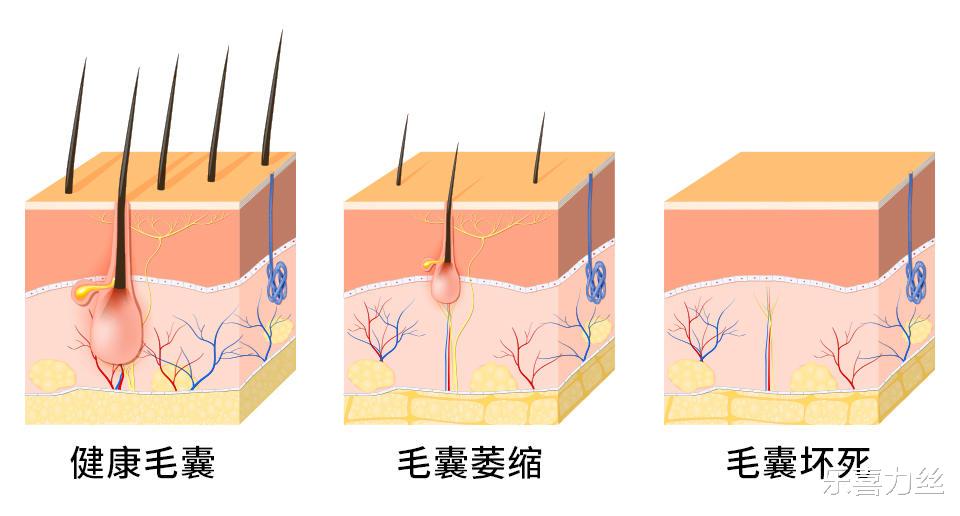 脱发|脱发还能再长出来吗？这几种情况下很难长出