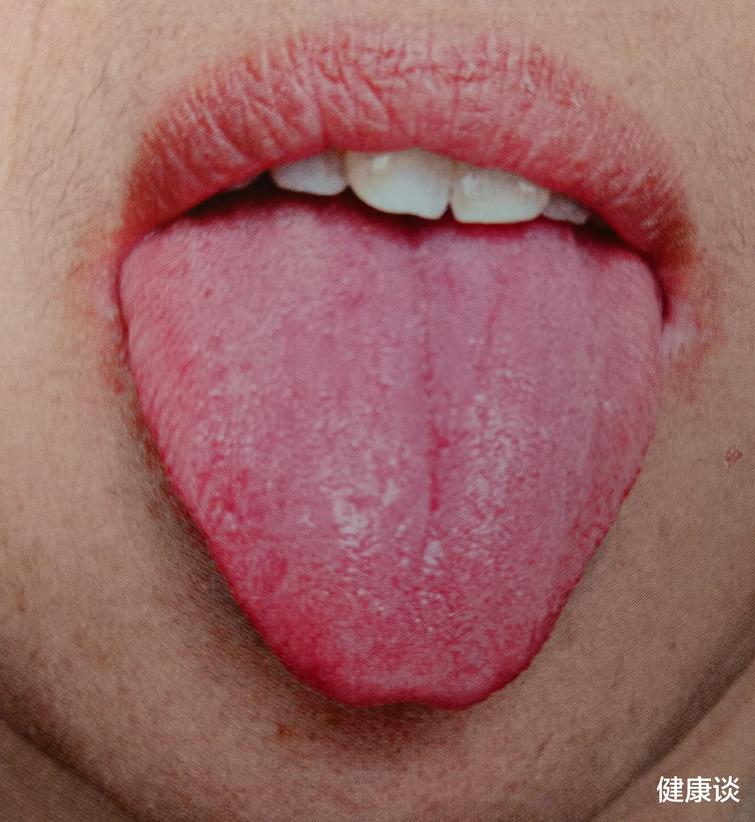 中药|老中医：中医4大虚症的舌象表现及茶饮方法