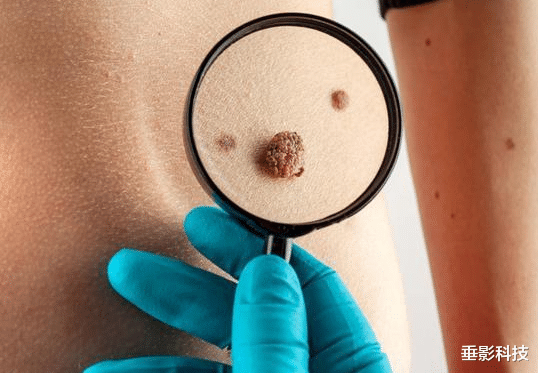 肝脏|医生提醒:身上长出这2种“小红点”,可能是肝在求救,别大意了