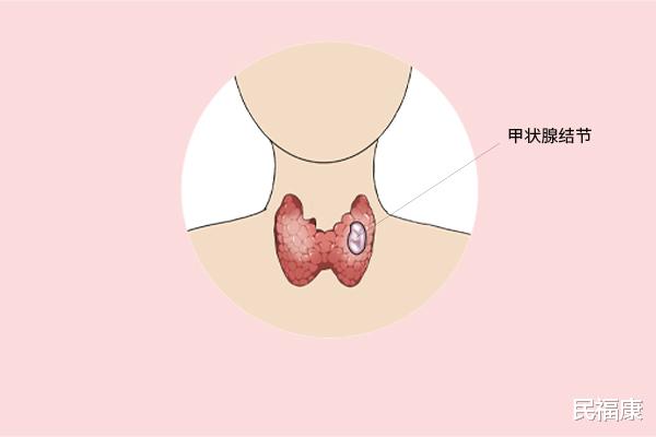 蔬菜|有3种蔬菜不适合甲状腺患者吃，对结节不友好，饮食调理不容忽视