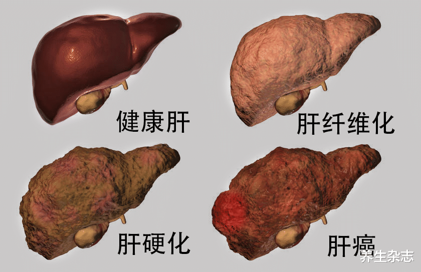 养生杂志|41岁男子转氨酶高达340，患上肝病，医生指出：与3种食物脱不了干系