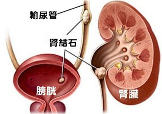 心肌梗塞|吃出来的结石！