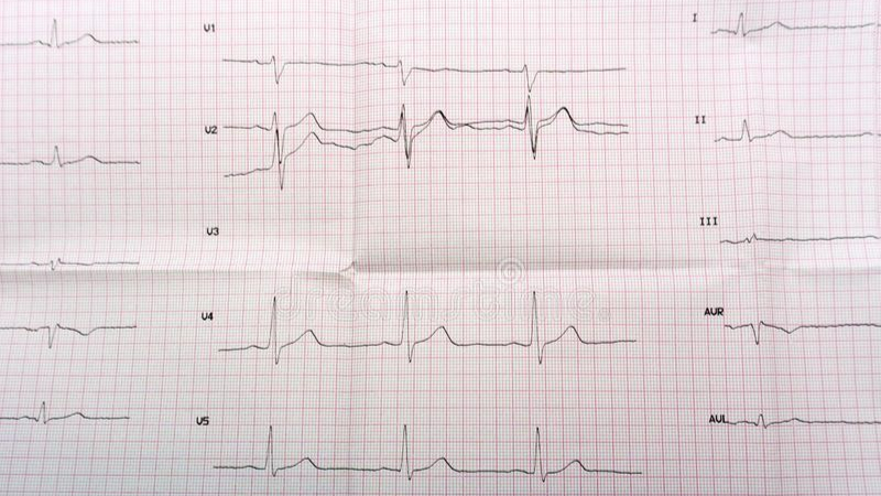 谈健|心脏支架手术是不是一劳永逸？术后该注意哪些问题？一文说清