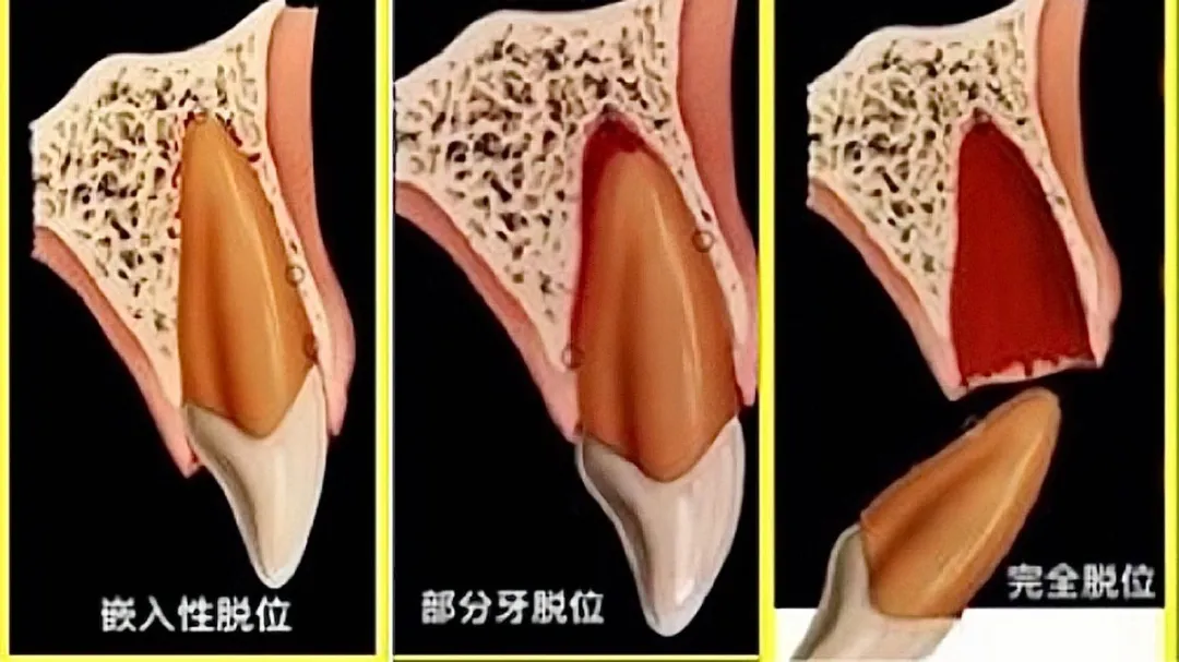 |磕掉的牙不要扔！可能怒亏几万块