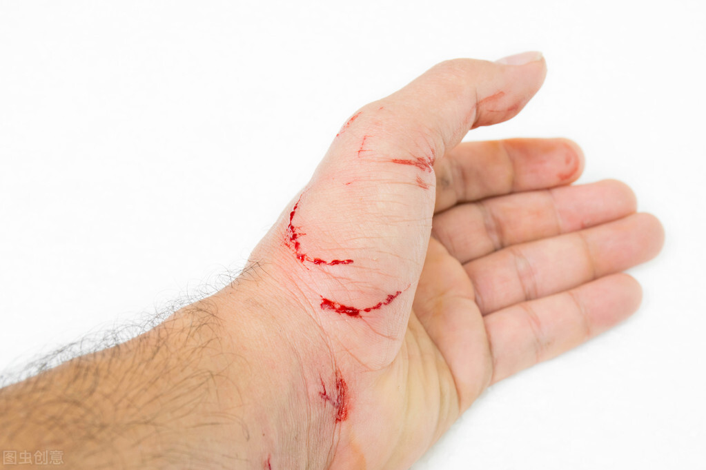  世界狂犬病日：狂犬病的病死率几乎是100%，被动物咬了怎么办？