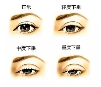 墨鱼|董雪:上睑下垂修复手术的坑有多深?丨科普篇