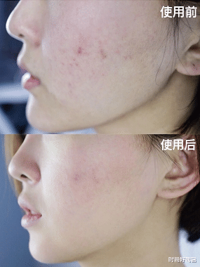 护肤|中国版美容“黑科技”诞生，效果堪比“医美”成为护肤界“小米”