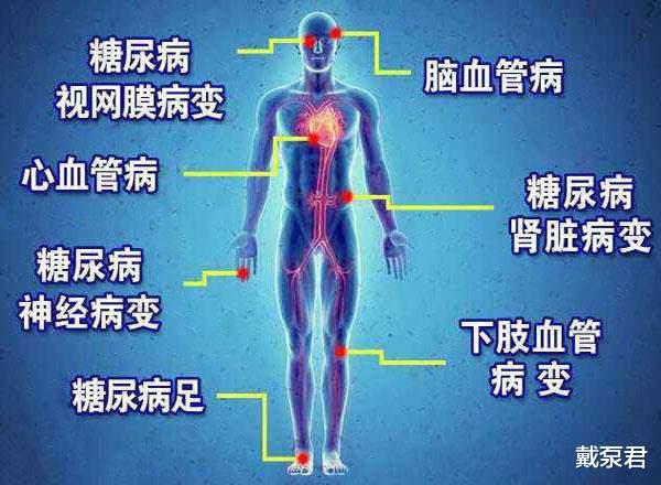 戴泵君|「答疑」糖尿病为什么会引发并发症？