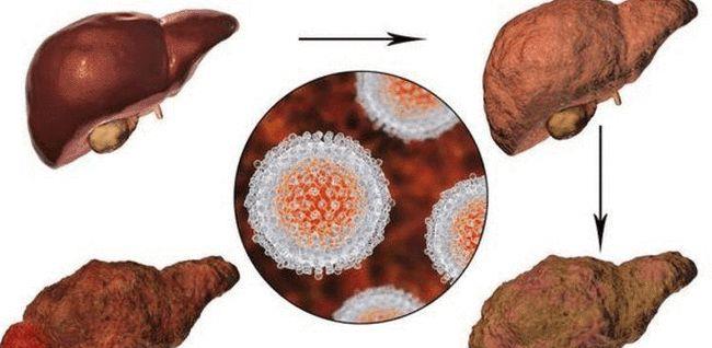 肝脏|一男子饭后晕倒，确诊肝硬化，医生训斥：这种粗粮不能常吃