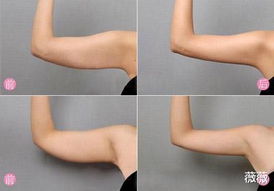 薇薇 女孩为爱坚持减肥40斤：你永远不知道，瘦下来的你究竟有多美丽！